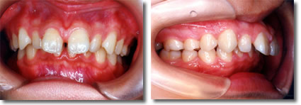 『出っ歯』上顎前突治療例