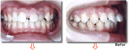 『すきっ歯』空隙歯列治療例