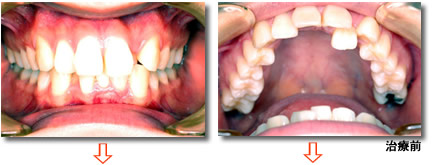 舌側矯正（STb装置）治療例