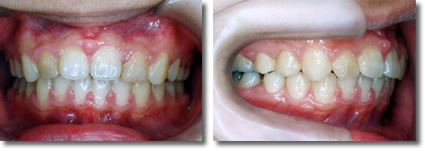 『出っ歯』上顎前突治療例2