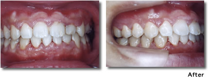 『すきっ歯』空隙歯列治療例2